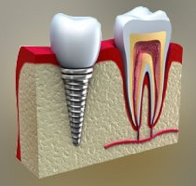Dental implants - Ofdentalcare